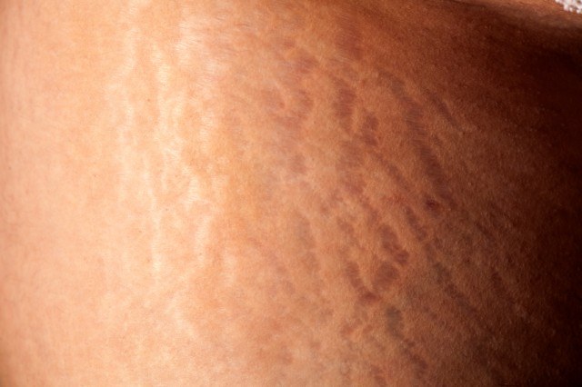 Did You Know Pregnancy Stretch Marks Could Be Genetic?